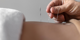 Dry Needling